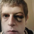 Leslie_black_eye_lol-thumb